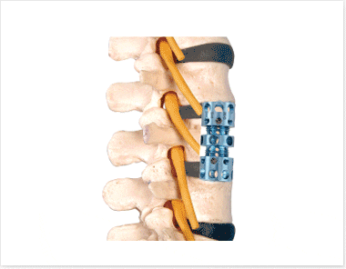 Distractable Anterior Spacer - Dorso Lumbar DAS