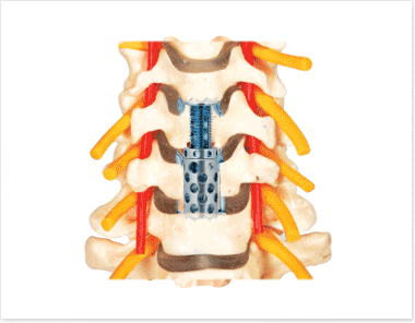 Distractable Anterior Spacer - Cervical DAS GESCO