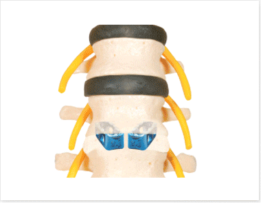 Posterior Lumbar Intervertebral Fusion Cage RECAGE
