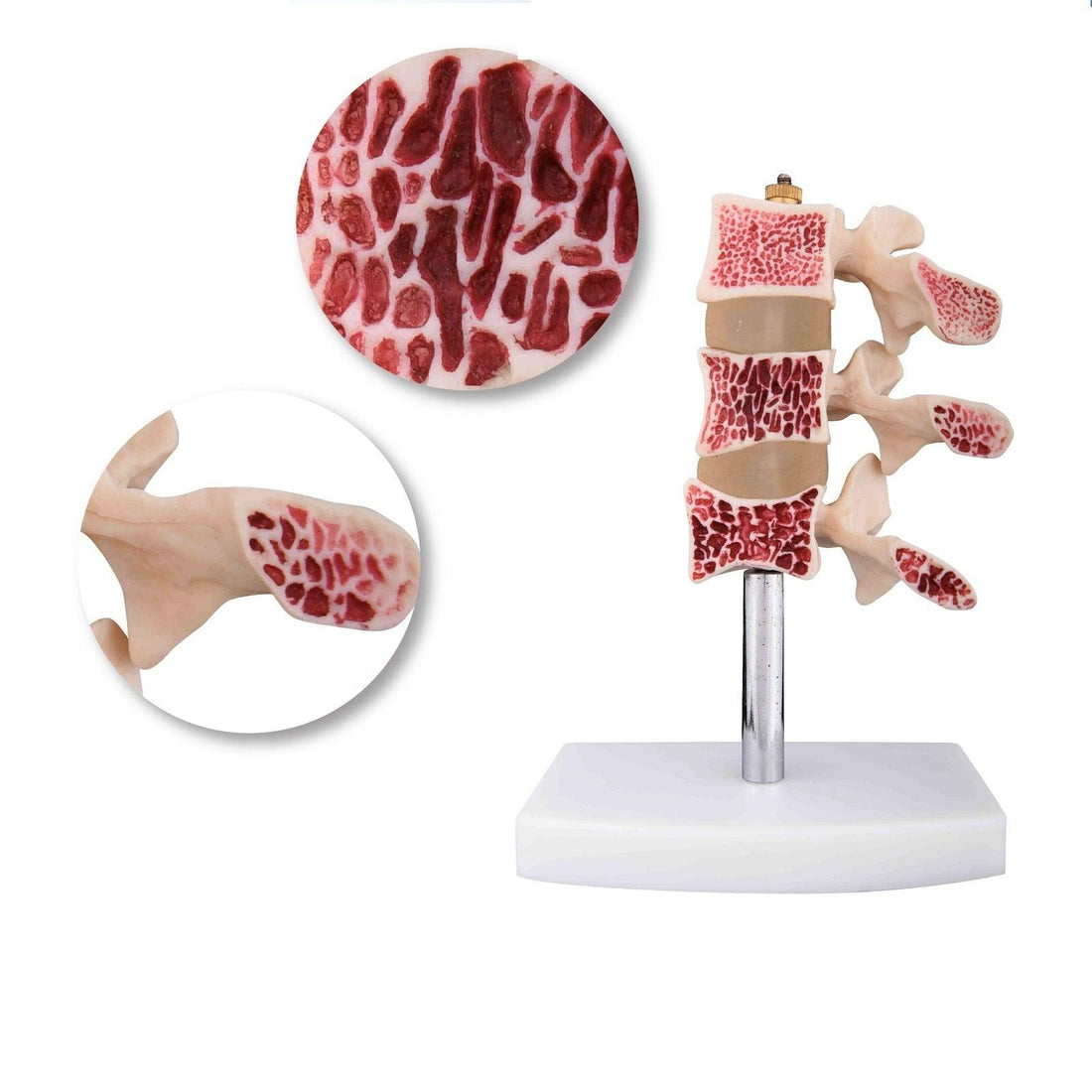 CUT AWAY OSTEOPOROSIS MODEL