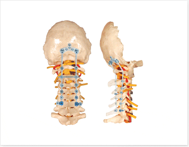 Occipito - Cervico - Thoracic Spinal Fixation System GESCO